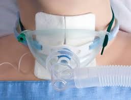 patient with trach tubing